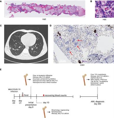 Case Report: Immune dysregulation associated with long-lasting regression of a (pre)leukemic clone